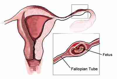 Ectopic (Tubal) Pregnancy